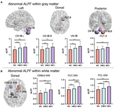 Whole-brain structure–function coupling abnormalities in mild cognitive impairment: a study combining amplitude of low-frequency fluctuations and voxel-based morphometry